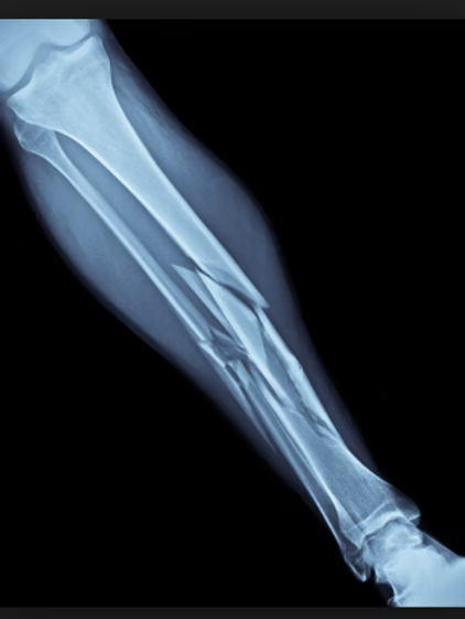 FracturesandDislocations